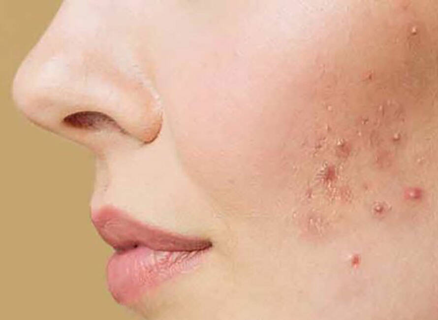 acne treatment in bearsden