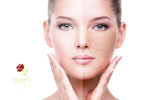 How to treat hyperpigmentation